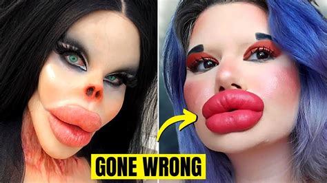 Plastic Surgery Gone Wrong Photos - Infoupdate.org