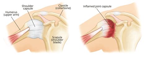 Frozen Shoulder | East Africa Orthopaedics