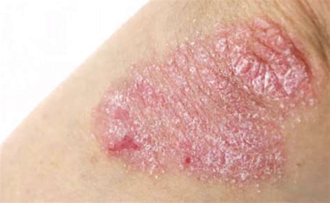 Nummular Eczema: 10 Symptoms Of Nummular Eczema