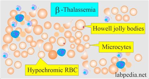 Anemia:- Part 4 - Thalassemia, α-thalassemia and β-thalassemia, Workup ...