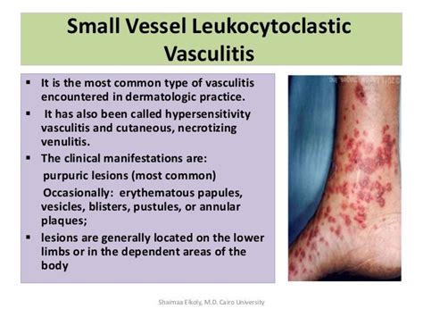 Vasculitis Treatment