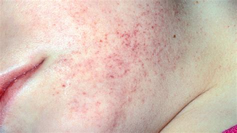 When to Worry About Petechiae: Symptoms and More