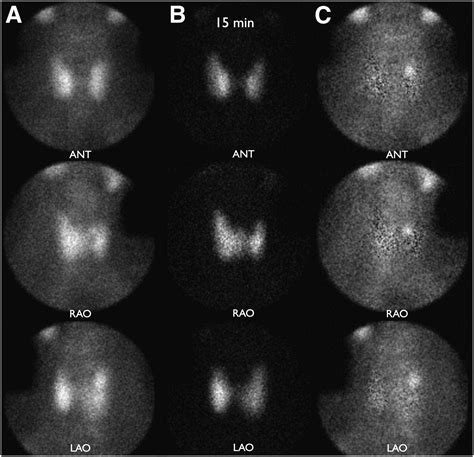 Parathyroid Imaging: The Importance of Dual-Radiopharmaceutical ...