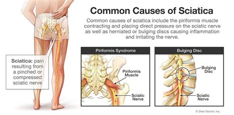 Sciatica | Spine Surgeon In The Woodlands, TX | Houston Advanced Spine ...