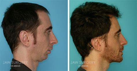 Long Face Syndrome Profile