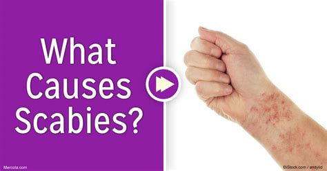 What Causes Scabies?