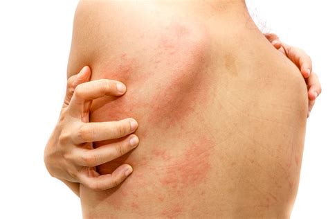 Acute Urticaria (Hives) - Utah Valley Dermatology