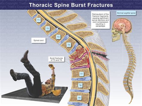 Thoracic Spine Burst Fractures - TrialQuest Inc.