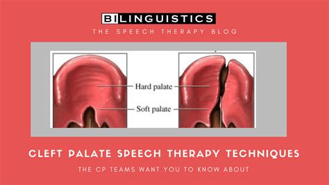 Cleft Palate Speech Therapy Techniques: CLP Team Tips