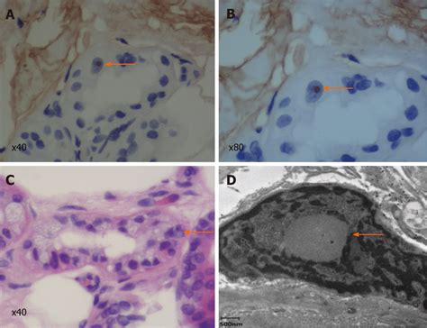 Skin biopsy specimen. A and B: Immunohistochemical staining showed that ...