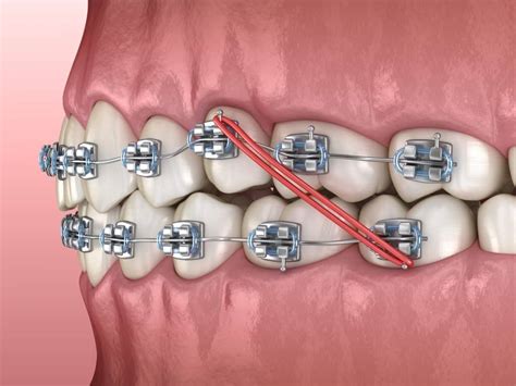 Rubber Bands in Your Mouth: Why You Need to Wear Elastics for Braces