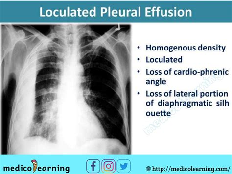 Pleural Effusion On X Ray