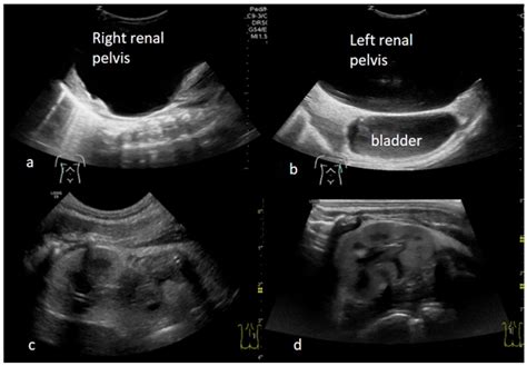 Severe Hydronephrosis Ultrasound