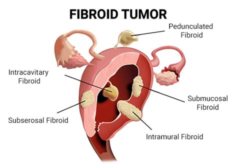 Fibroid Tumor Treatment in Brooklyn and Bronx | Fibroid Cancer ...