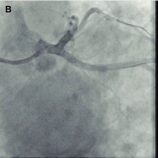 (A) 4.5×9 mm bare metal stent was directly implanted in the proximal ...