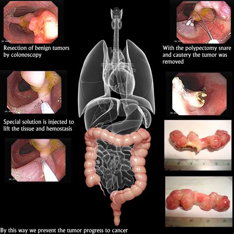 Polyps - Notes on Cyber Gastroenterology - murrasaca.com