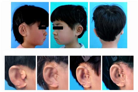 Children get new ears grown from their own cells in world first | New ...