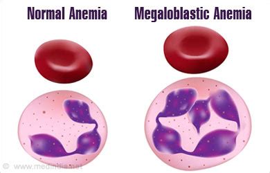 Megaloblastic Anemia - Causes, Symptoms, Signs, Diagnosis, Treatment ...