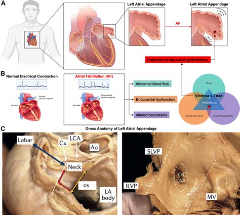 Left Atrial Appendage Occlusion: Current Stroke Prevention Strategies ...