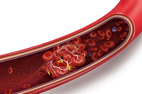 Know the Warning Signs of a Blood Clot - UMMS Health