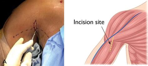 Biceps Tendinitis - OrthoInfo - AAOS