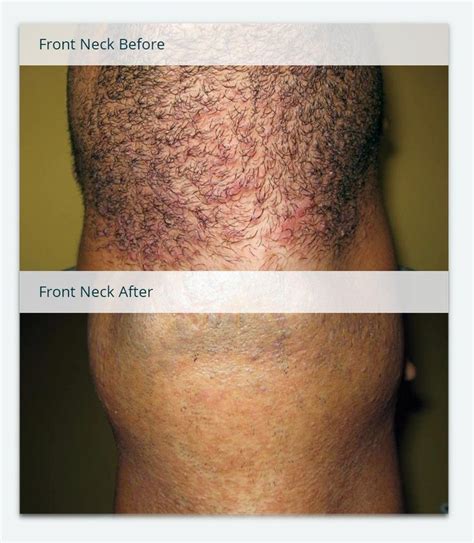 laser hair removal before and after dark skin - Ray Beaver