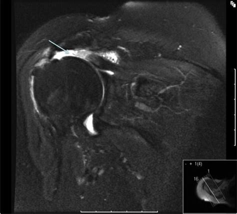 Rotator Cuff Tear On Mri