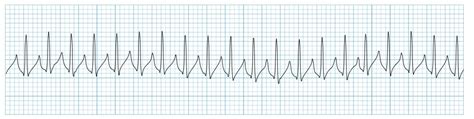 Paroxysmal Atrial Tachycardia Vs Sinus Tachycardia