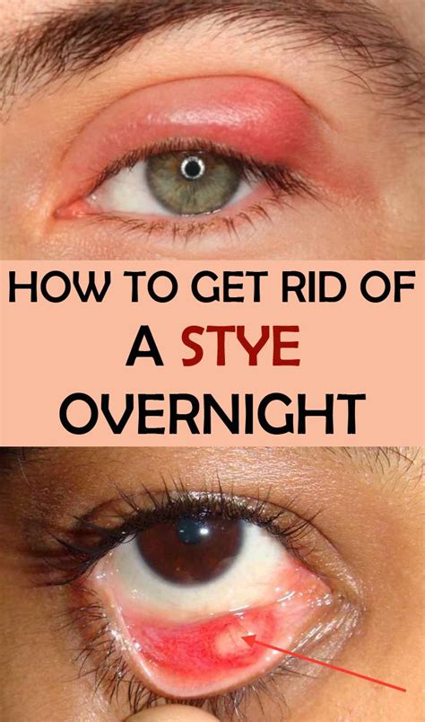 How To Get Rid Of a Stye Overnight | HEALING THE ORGANIC WAY | Eye stye ...