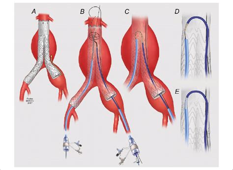 Iliac Artery Dissection