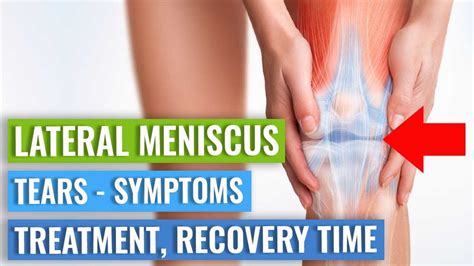 LATERAL Meniscus Tears: Symptoms, Treatment (Surgery vs. Exercise ...