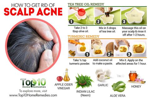 How to Get Rid of Scalp Acne | Top 10 Home Remedies