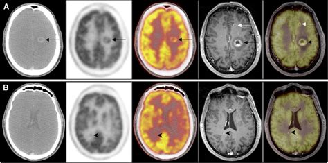 Oncologic PET/MRI, Part 1: Tumors of the Brain, Head and Neck, Chest ...