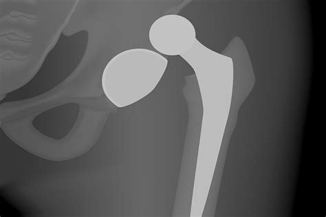 Hip dislocation following surgery - avoid hip dislocation with these tips