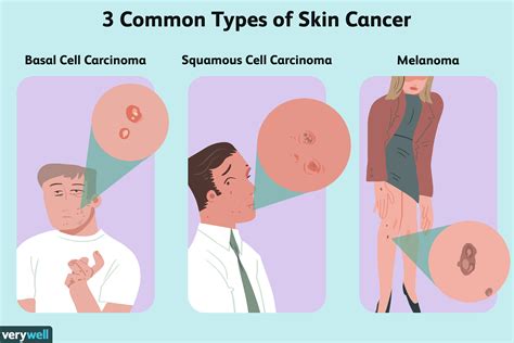 Skin Cancer: Overview and More