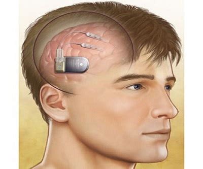 Asia Pacific Neurostimulation Devices Market - TechSci Blog