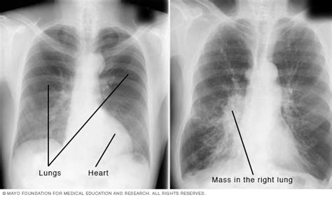 Chest X-rays | Beacon Health System