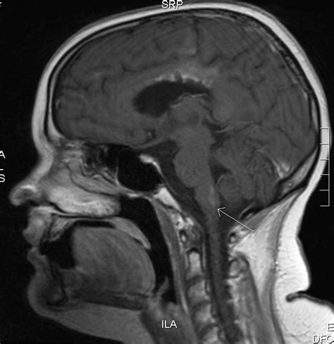 MRIs – Sadie's Brain Tumor