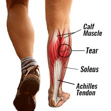 Calf Muscle Tears: Symptoms, Complications, and Treatments | Physio Fit ...