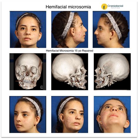 Hemifacial Microsomia Gallery - Dell Children's Craniofacial Team of Texas