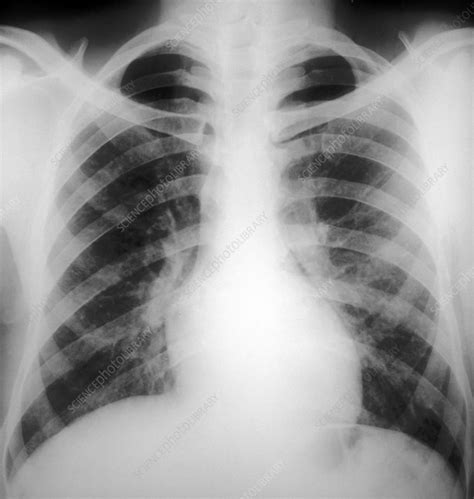 Bronchitis Lungs Xray