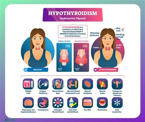 UNDERACTIVE THYROID (HYPOTHYROIDISM) - Symptoms, Causes, Risk Groups ...