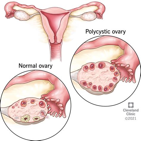 PCOS - DarianFarouk