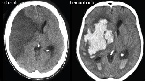 Diagnosis and Treatment - STROKES