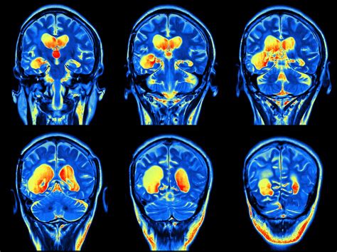 Ms Brain Mri With Contrast