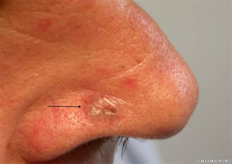 BCC (Basal Cell Carcinoma)