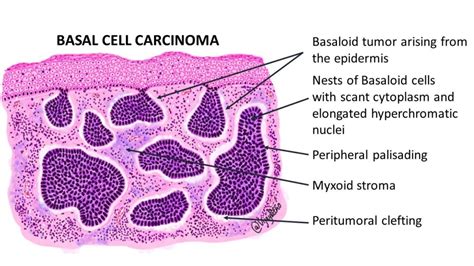 BASAL CELL CARCINOMA - Pathology Made Simple