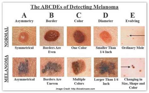 WSU Plastic Surgery Skin Cancer In-Service Prep Jeopardy Template