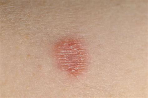 Skin Rashes Types and Causes in Children