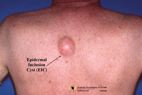 [DIAGRAM] Diagram Of Epidermal Inclusion Cyst - MYDIAGRAM.ONLINE